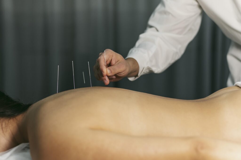 acupuncture needles
